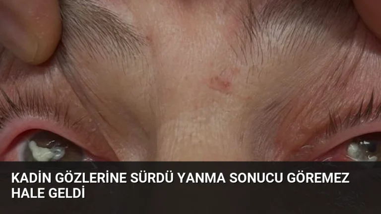 Kadin Gözlerine Sürdü Yanma Sonucu Göremez Hale Geldi