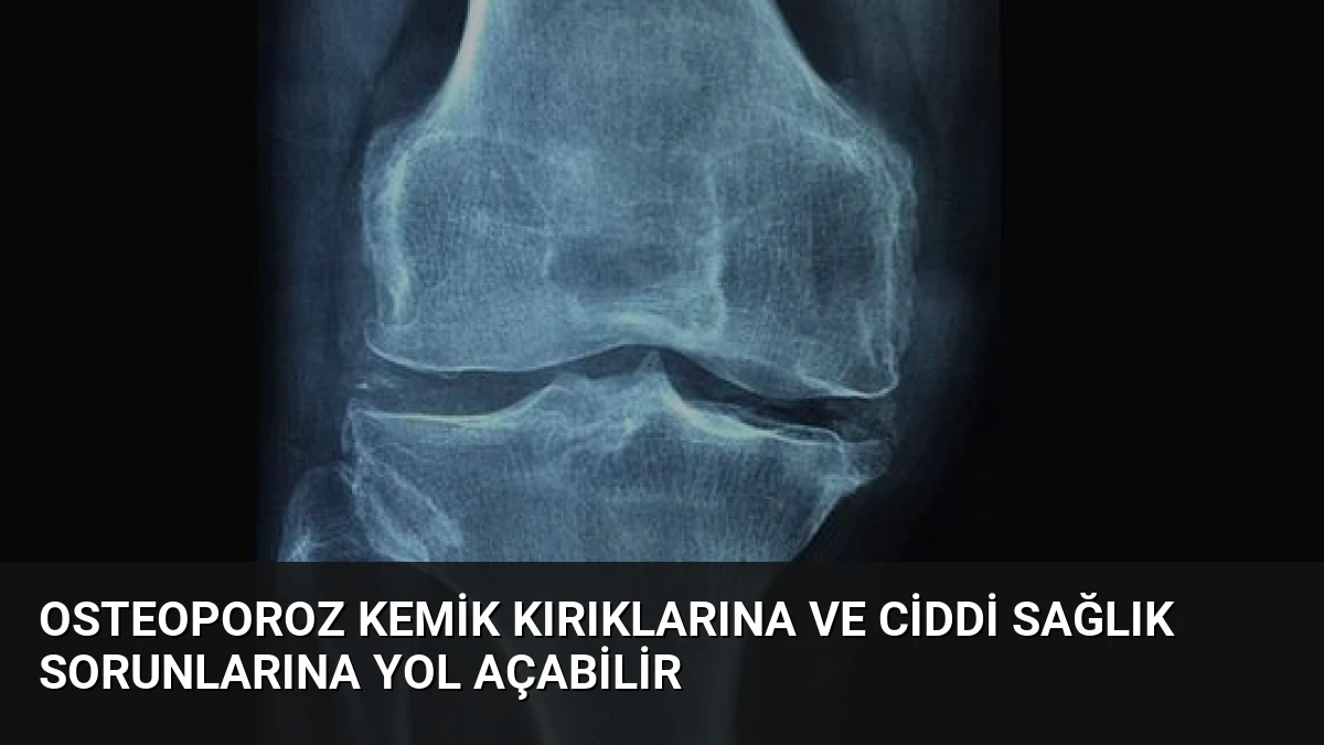 Osteoporoz Kemik Kırıklarına ve Ciddi Sağlık Sorunlarına Yol Açabilir