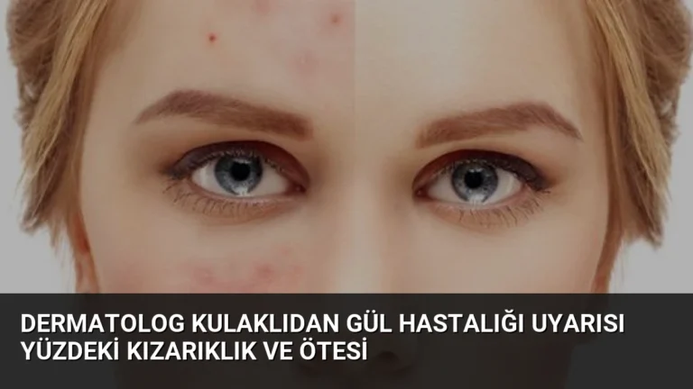 Dermatolog Kulaklıdan Gül Hastalığı Uyarısı Yüzdeki Kızarıklık ve Ötesi