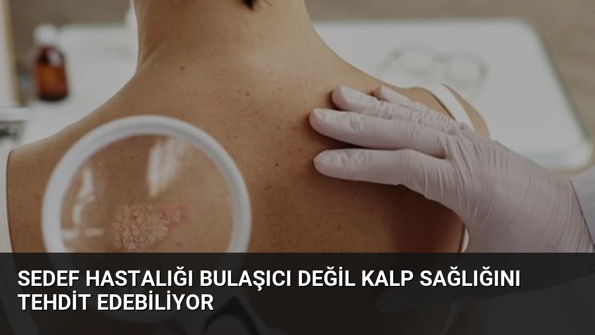 Sedef Hastalığı Bulaşıcı Değil Kalp Sağlığını Tehdit Edebiliyor